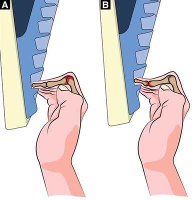 Clinical management of finger joint capsulitis/synovitis in a rock climber